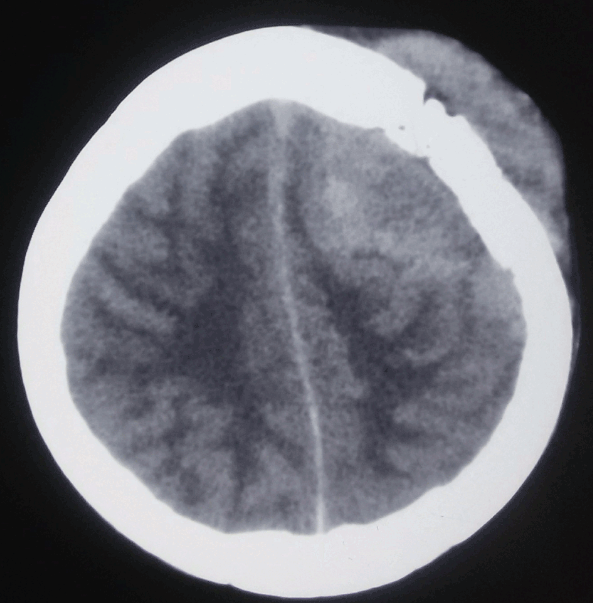 Primary CNS lymphoma presenting as a hyperdense calvarial based lesion