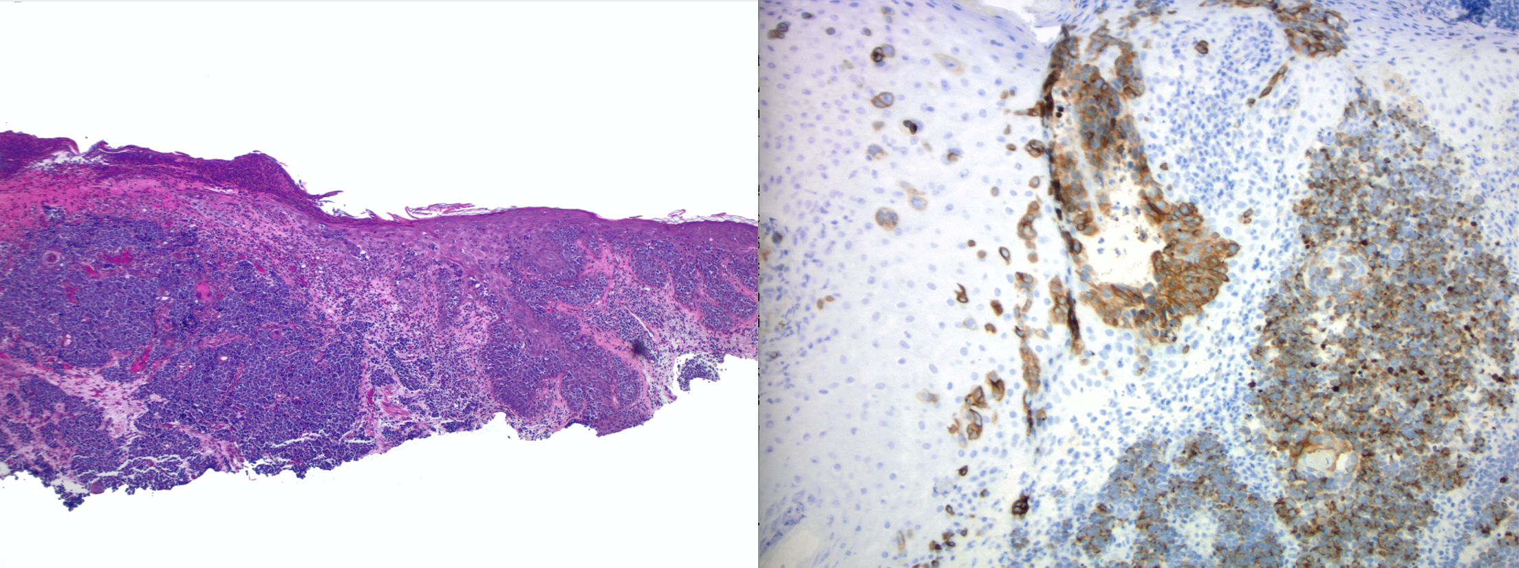 <p>Merkel Cell Carcinoma