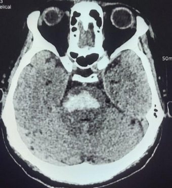 Pontine hemorrhagic stroke