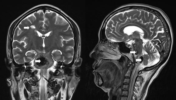 Cavernoma bleed in the brainstem