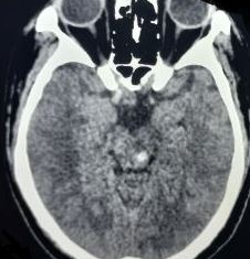 Diffuse axonal injury Type III