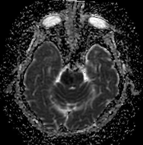 Pontine infarction