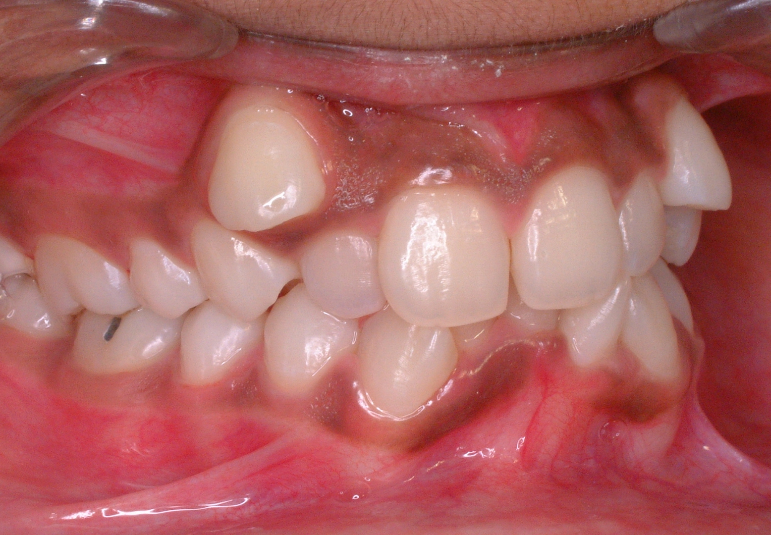 Angle class I molar relationship and Dewey type 1.