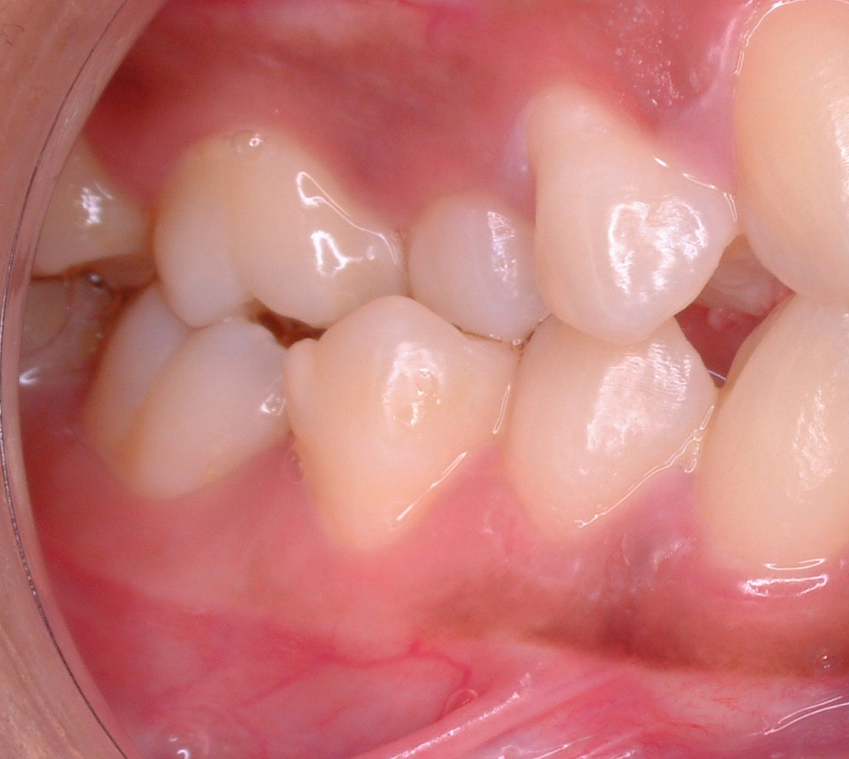 Angle class II molar relationship.