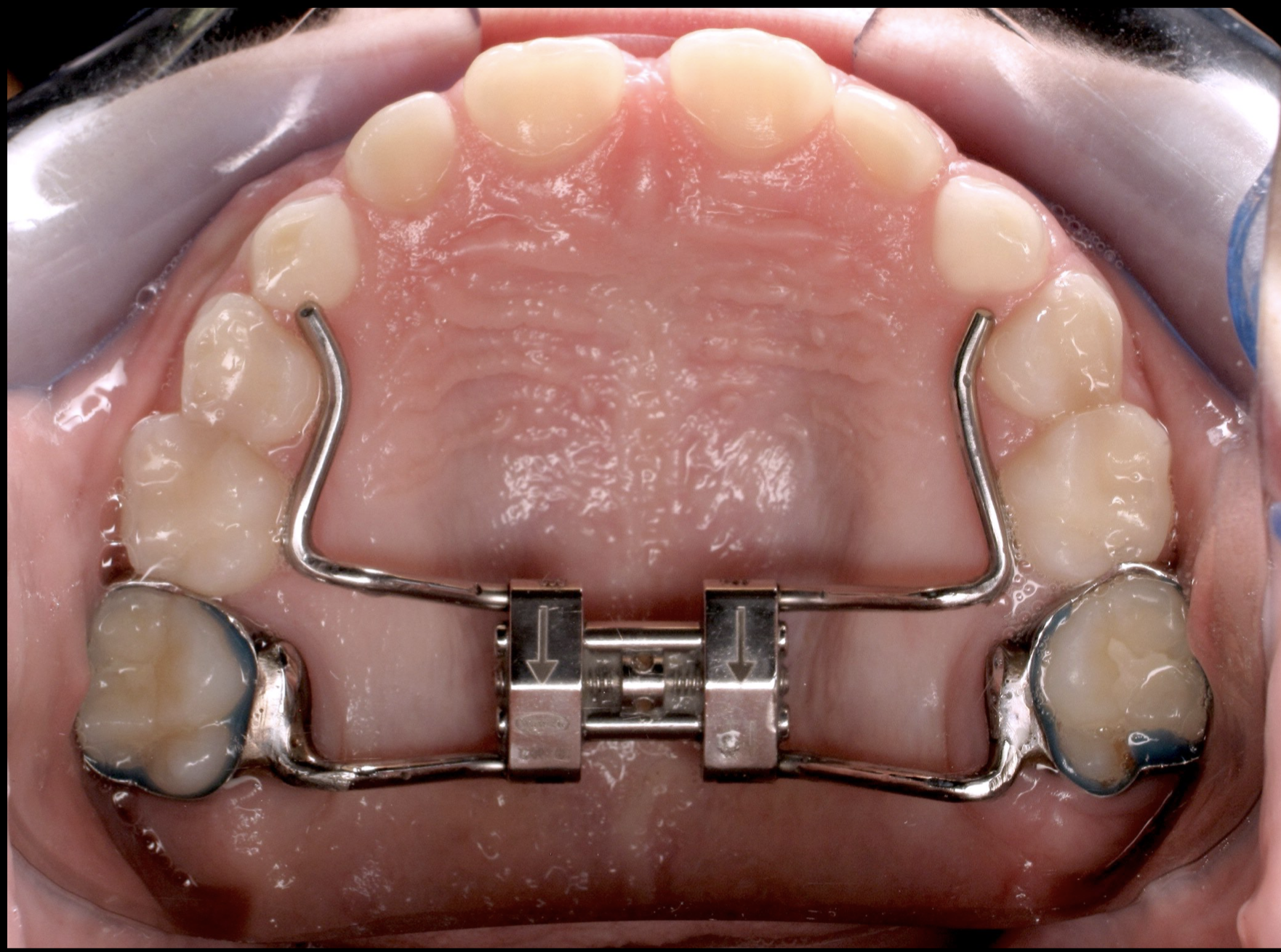 Hyrax rapid palatal expander.