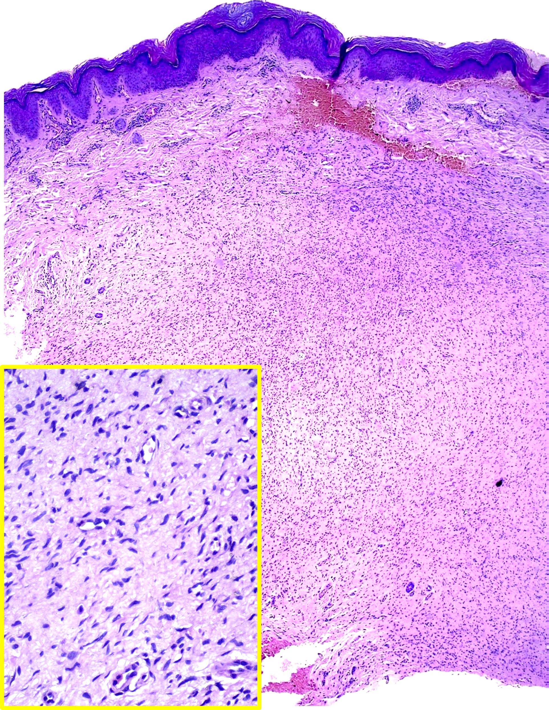 <p>Neurofibroma