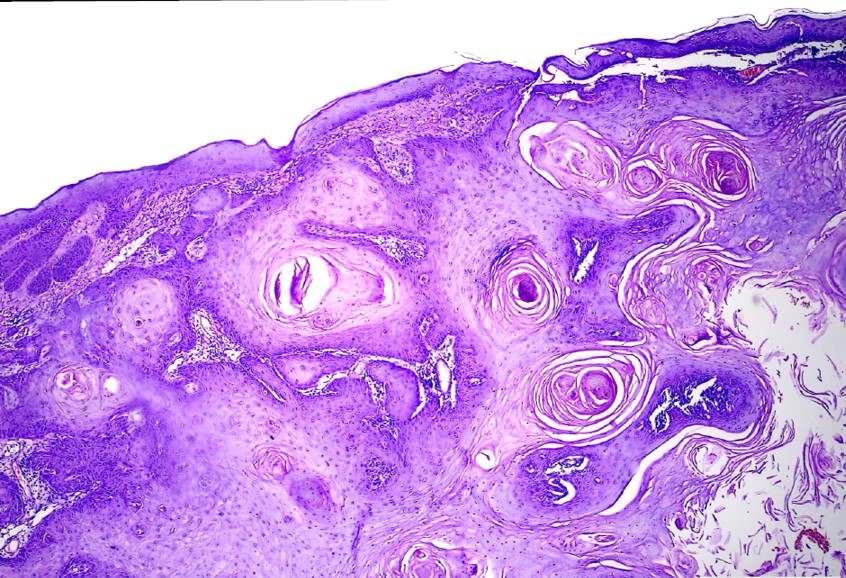 <p>Squamous Cell Carcinoma