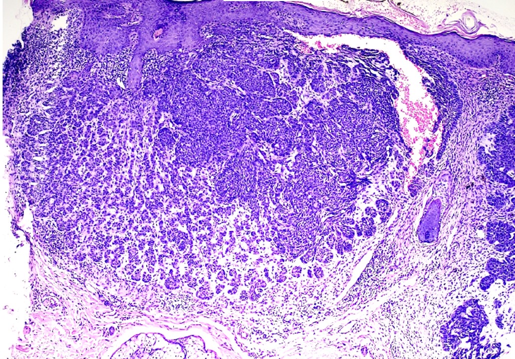 <p>Basal Cell Carcinoma
