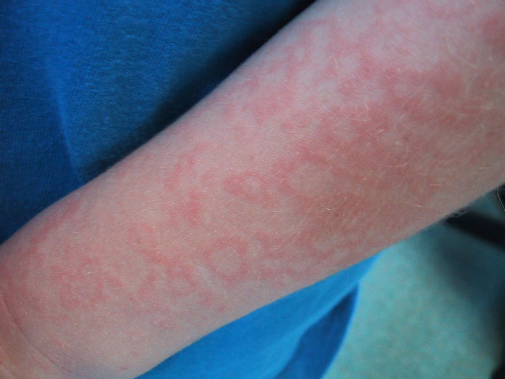 Fifth Disease, Arm