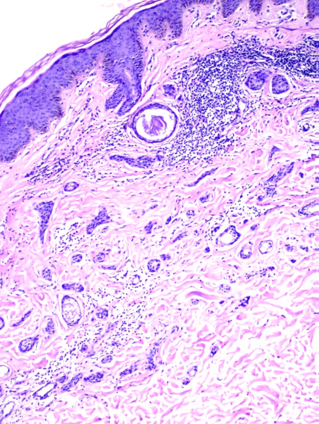 <p>Syringoma