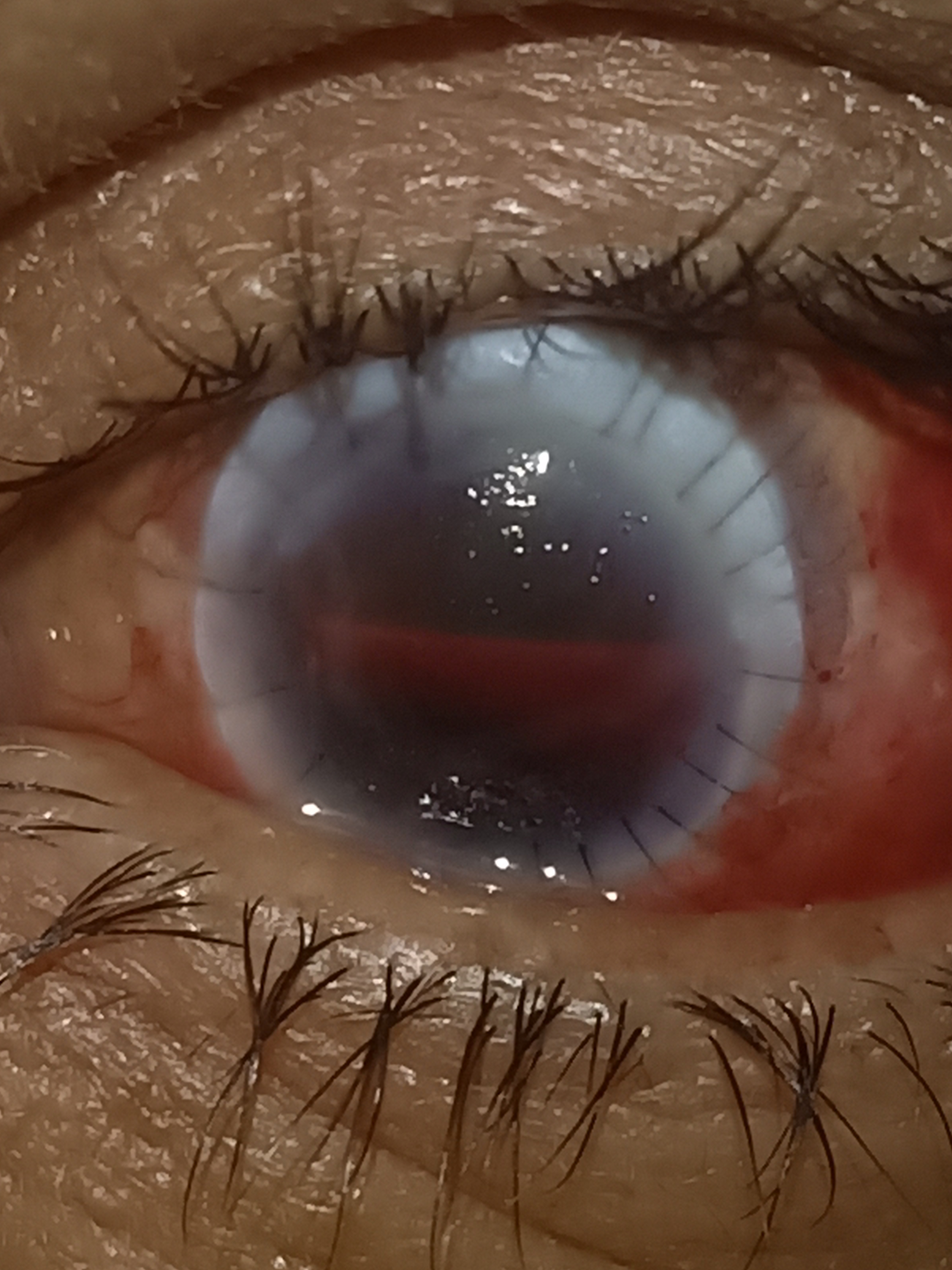 Digital image of the patient depicting hyphema post optical penetrating keratoplasty