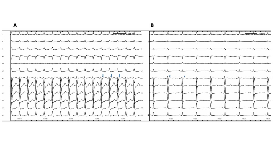 Typical Pseudo-R Waves