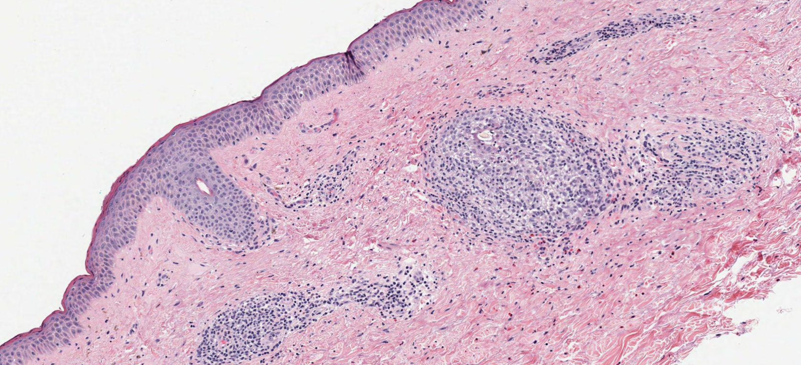 <p>Eosinophilic Pustular Folliculitis. Skin biopsy; hematoxylin and eosin stain.</p>