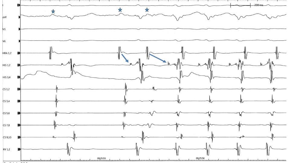 AVNRT AH Intervals