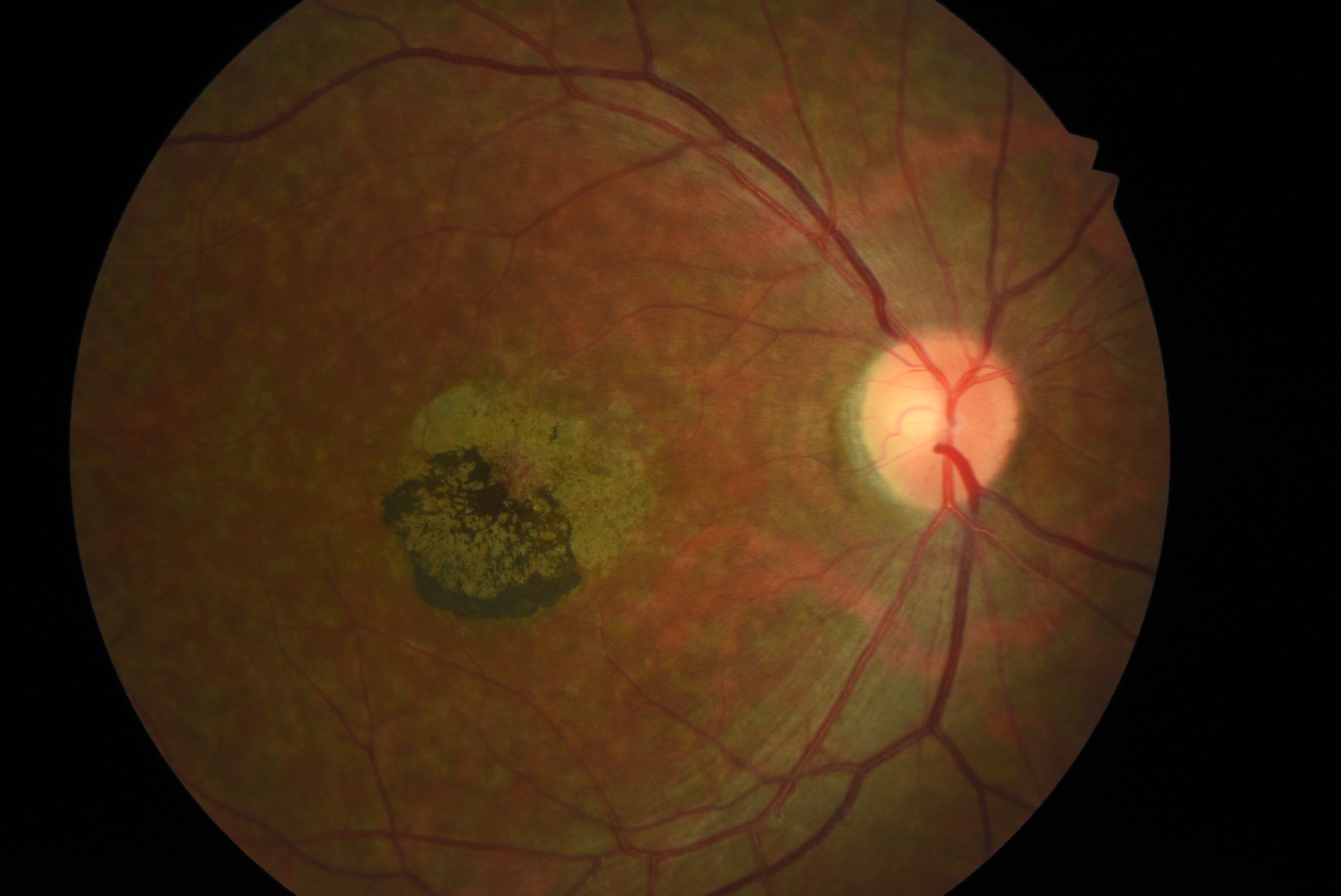 <p>Stargardt Disease. Flecks and macular atrophy in a patient with autosomal recessive Stargardt disease.</p>