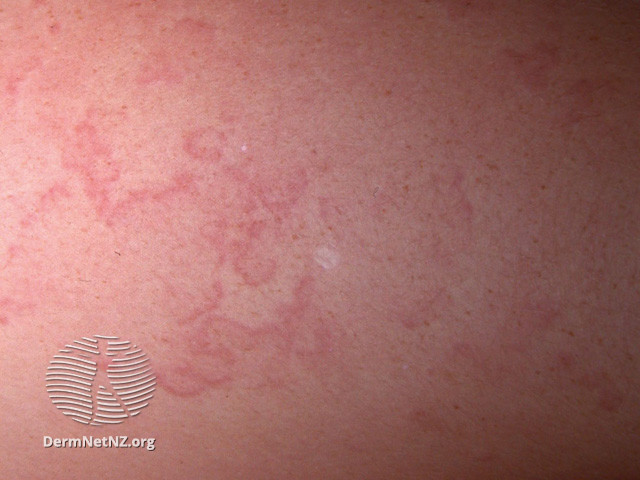 Erythema Marginatum