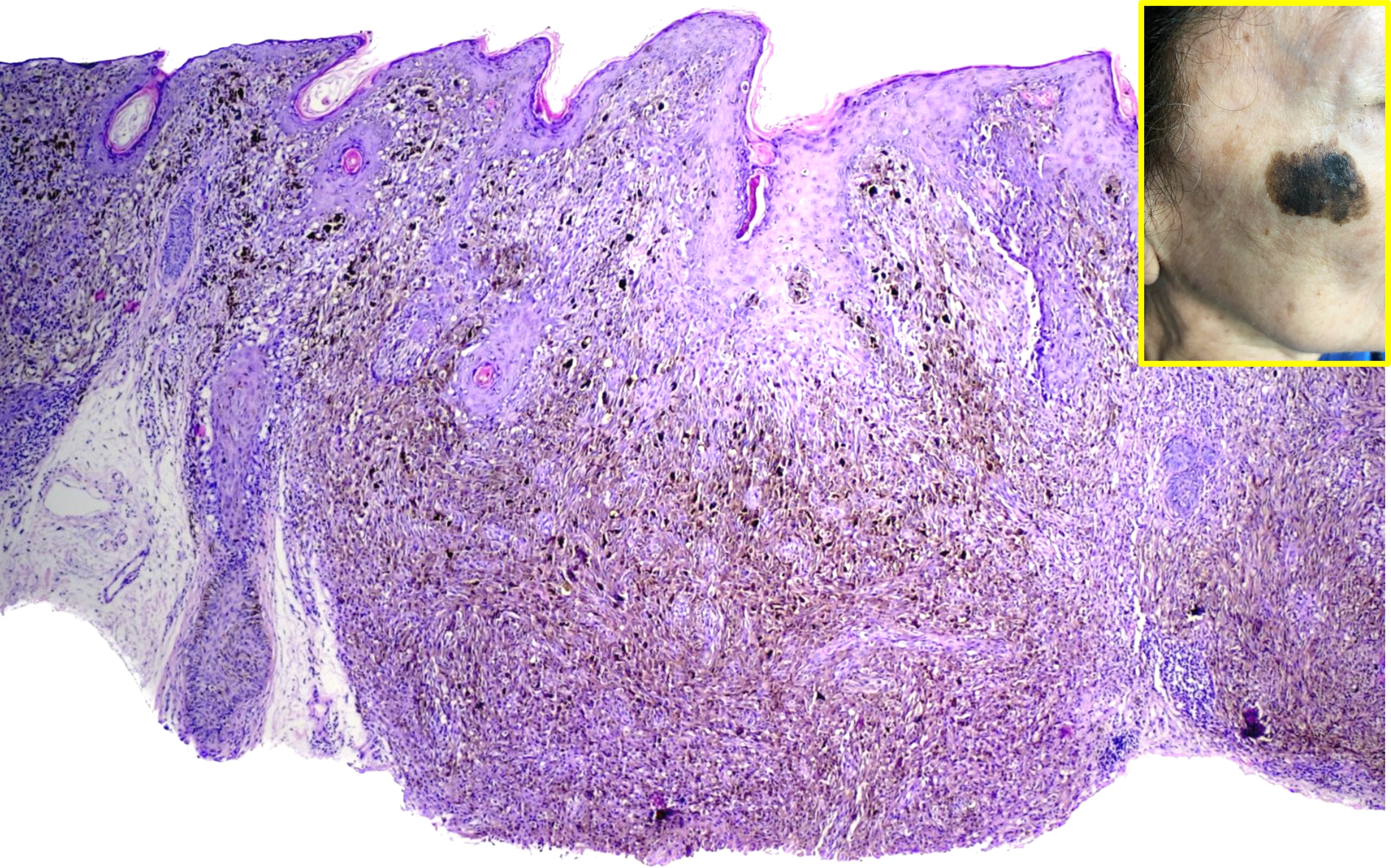 <p>Lentigo Maligna with Invasive Melanoma