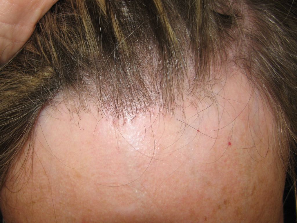 Frontal Fibrosing Alopecia