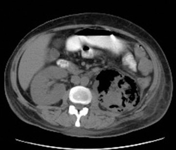 <p>Emphysematous Pyelonephritis. CT features of left-sided emphysematous pyelonephritis (axial cut).</p>