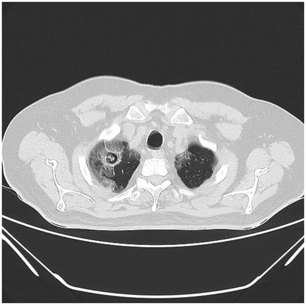 <p>HRCT Showing Characteristic Fungal Ball of Aspergilloma With Features of SARS-CoV-2 Pneumonitis