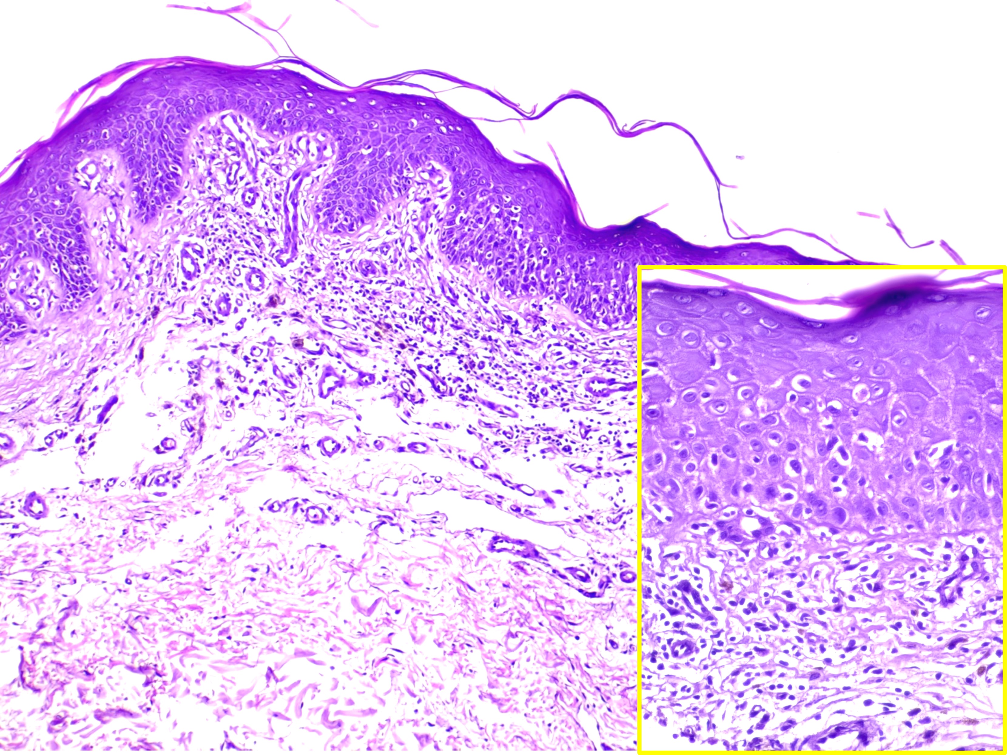 <p>Mycosis Fungoides