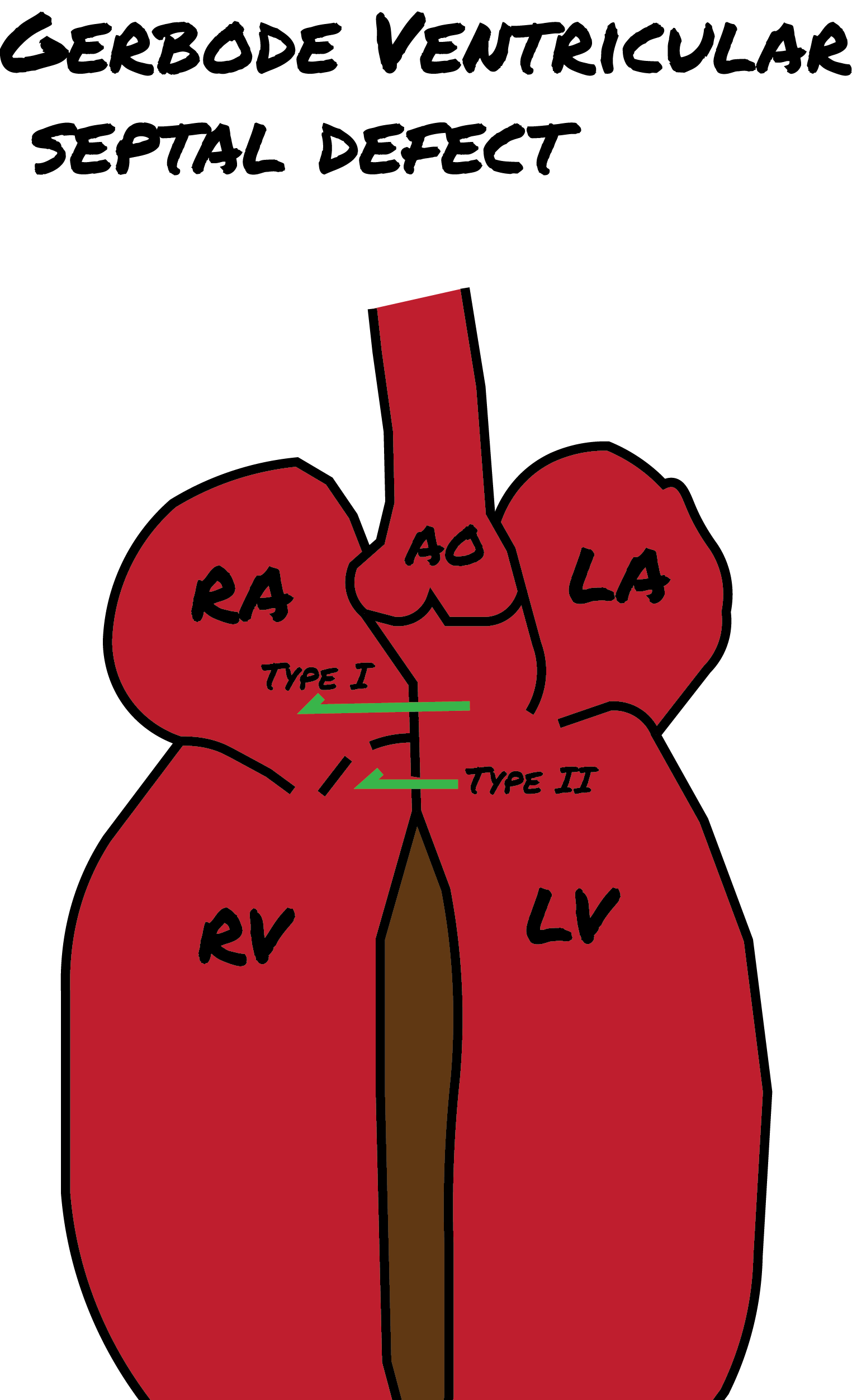 <p>Gerbode Defects. Illustration of supra- and subvalvular defects associated with Gerbode ventricular septal defects.</p>