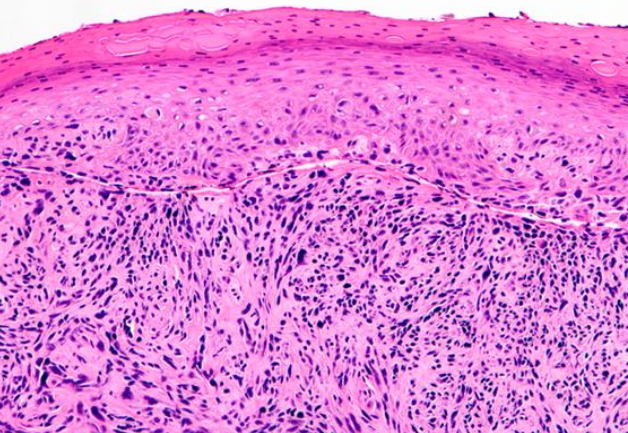 <p>Histological Slide of Squamous Cell Carcinoma, Sarcomatoid