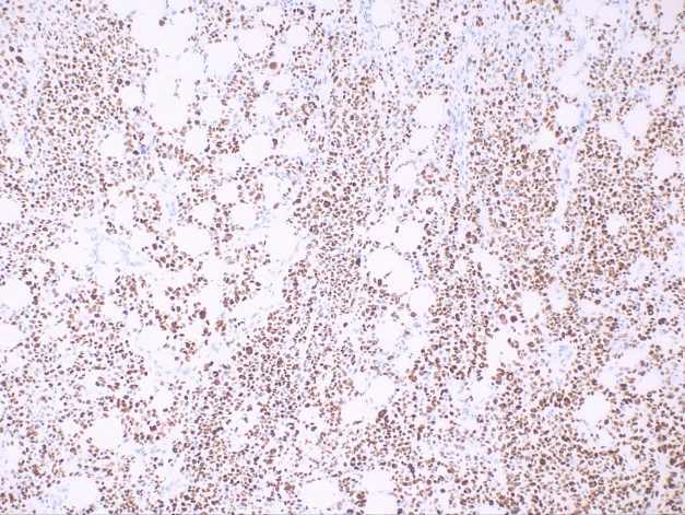 <p>Histological Slide of Squamous Cell Carcinoma, Positive p40 Stain