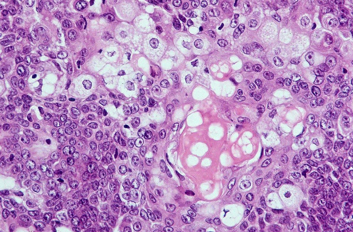 <p>Sebaceous Carcinoma