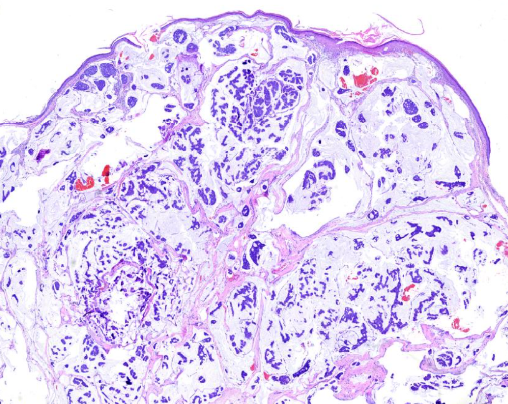 <p>Primary Cutaneous Mucinous Carcinoma