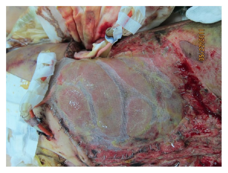 <p>Polypropylene Mesh Abdominal Closure