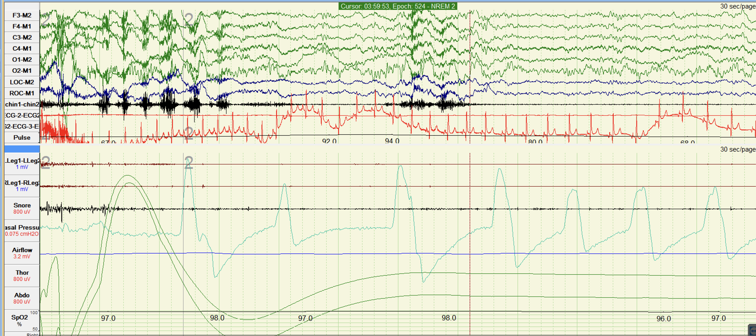 <p>Polysomnographic Record During Sleep