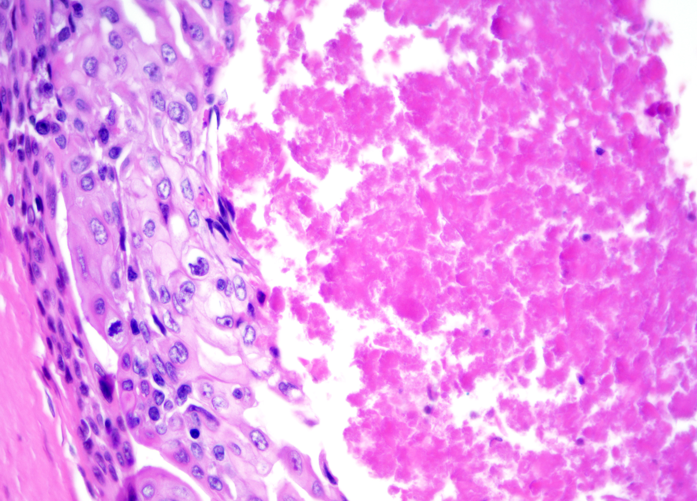 <p>Trichilemmal Carcinoma