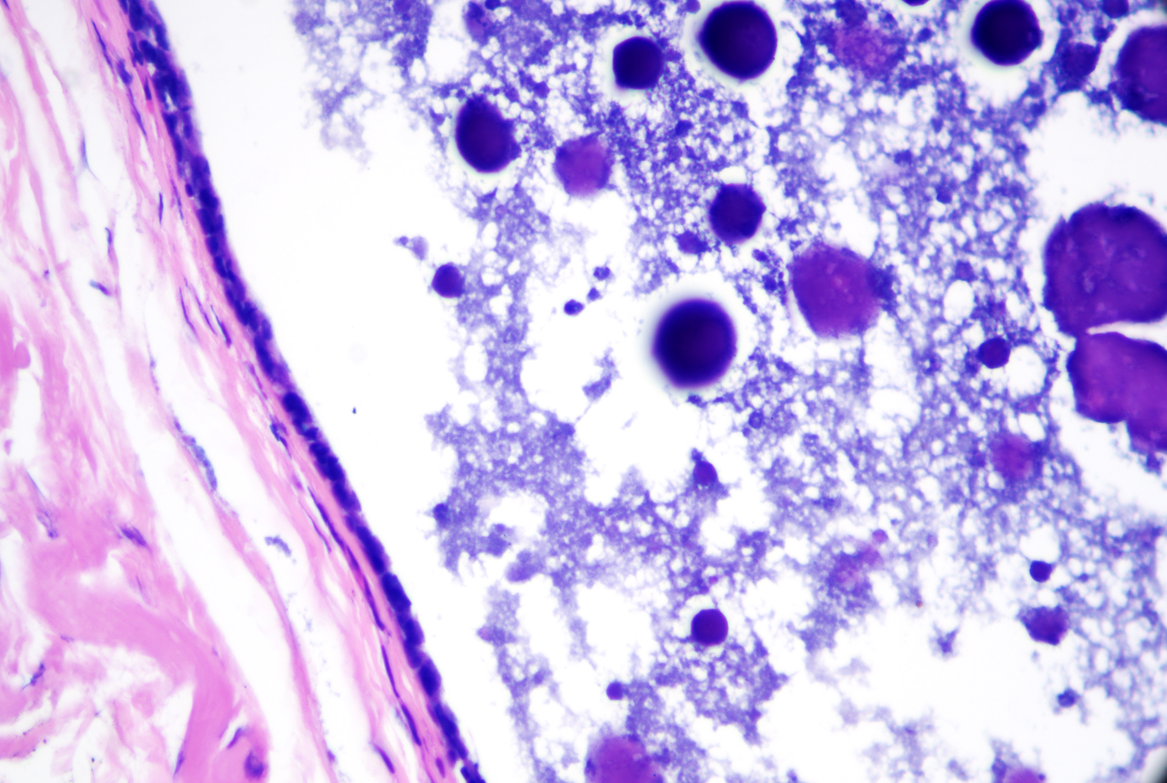 <p>Thyroglossal Duct Cyst. These cysts have variable lining epithelium, in this case, simple cuboidal. H&amp;E x200.</p>