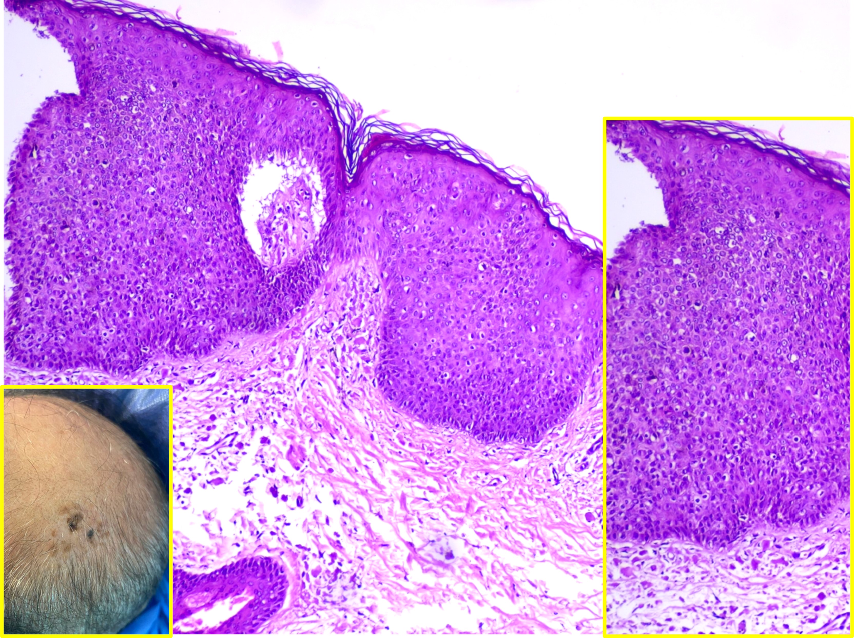 <p>Actinic Keratosis