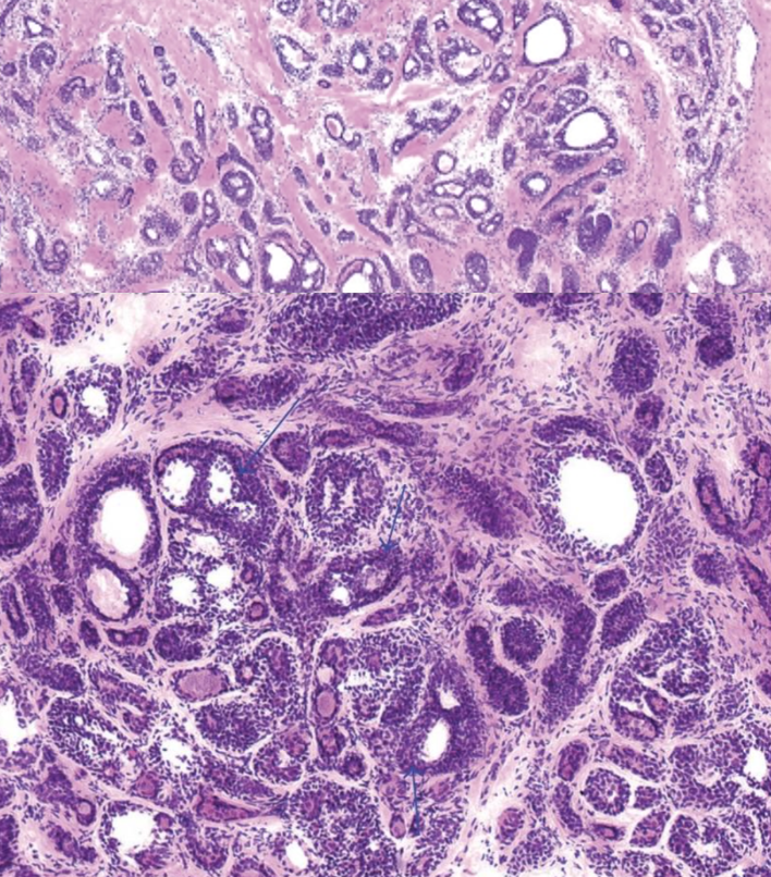 <p>Adenoid Cystic Carcinoma