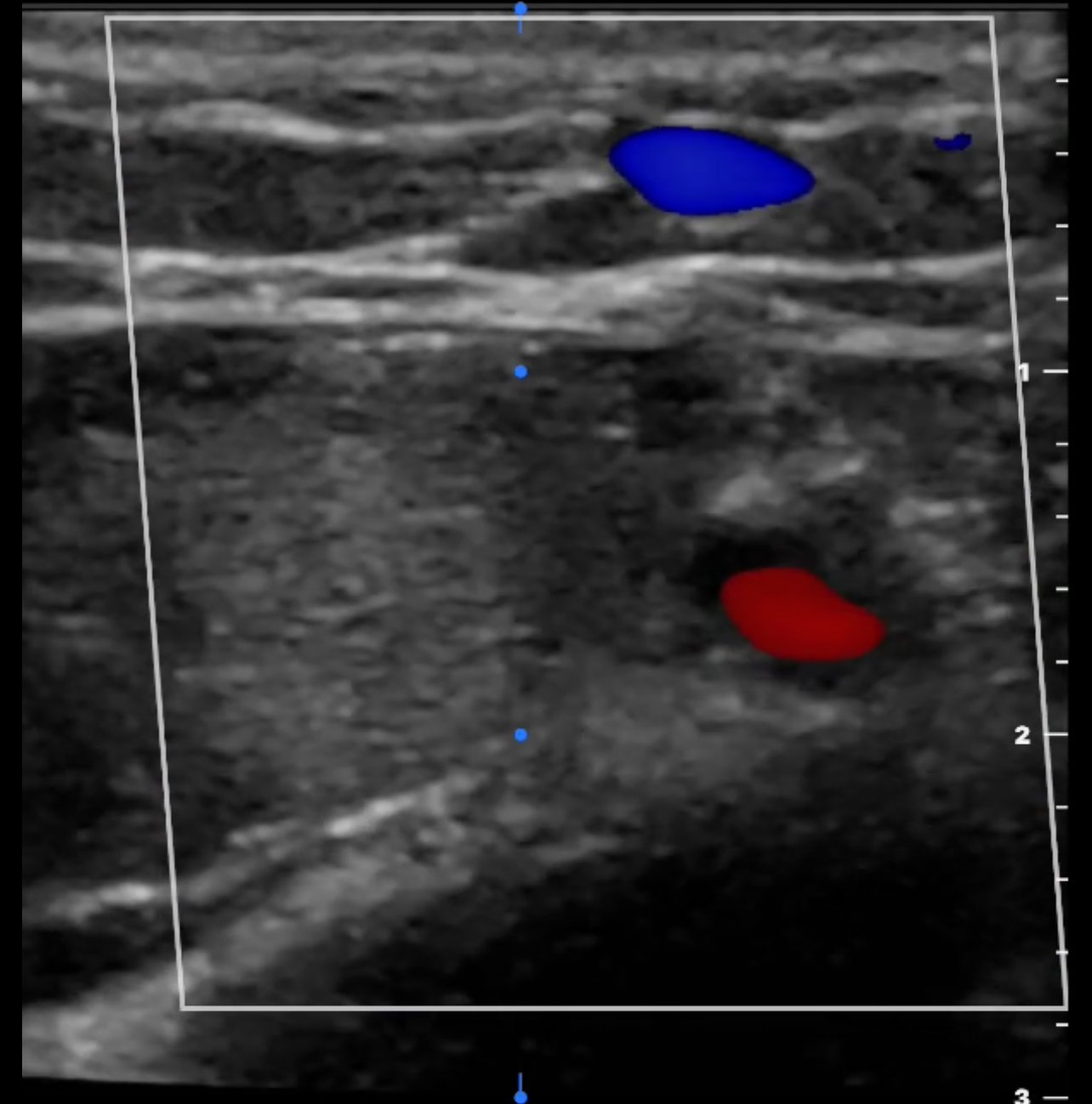 <p>Color Doppler Ultrasound of&nbsp;Artery&nbsp;versus&nbsp;Vein