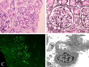 <p>Histopathological Characteristics of IgA Nephropathy