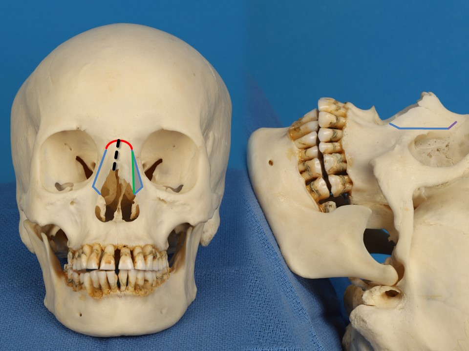 <p>Nasal Osteotomies for Shifting a Deviated Bony Vault