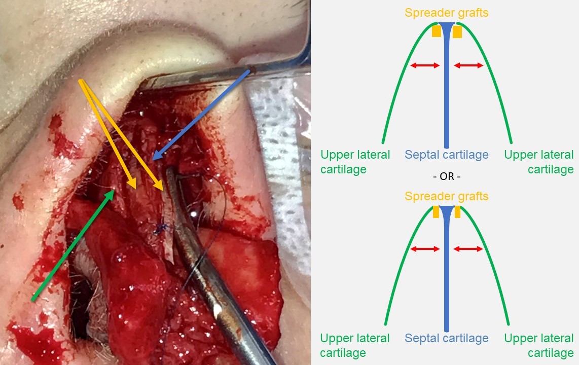 <p>Spreader Grafting