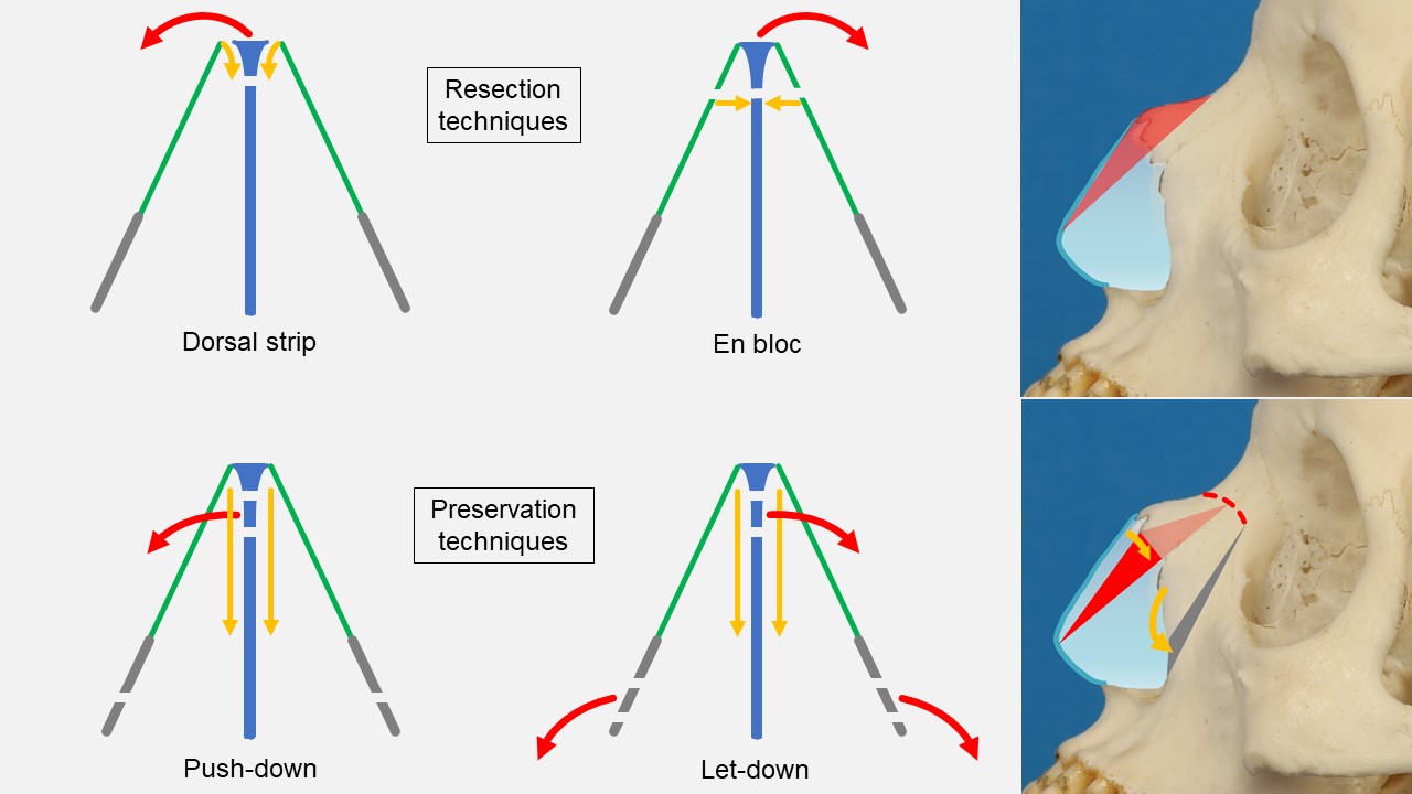 <p>Dorsal Hump Reduction