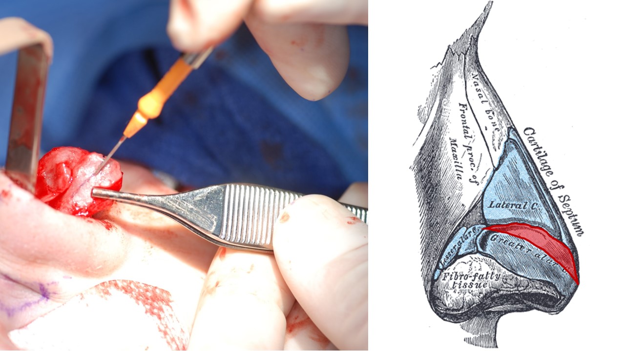 <p>Cephalic Trimming