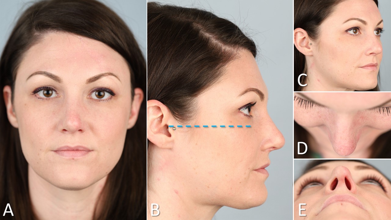 <p>Standard Photographs for Rhinoplasty