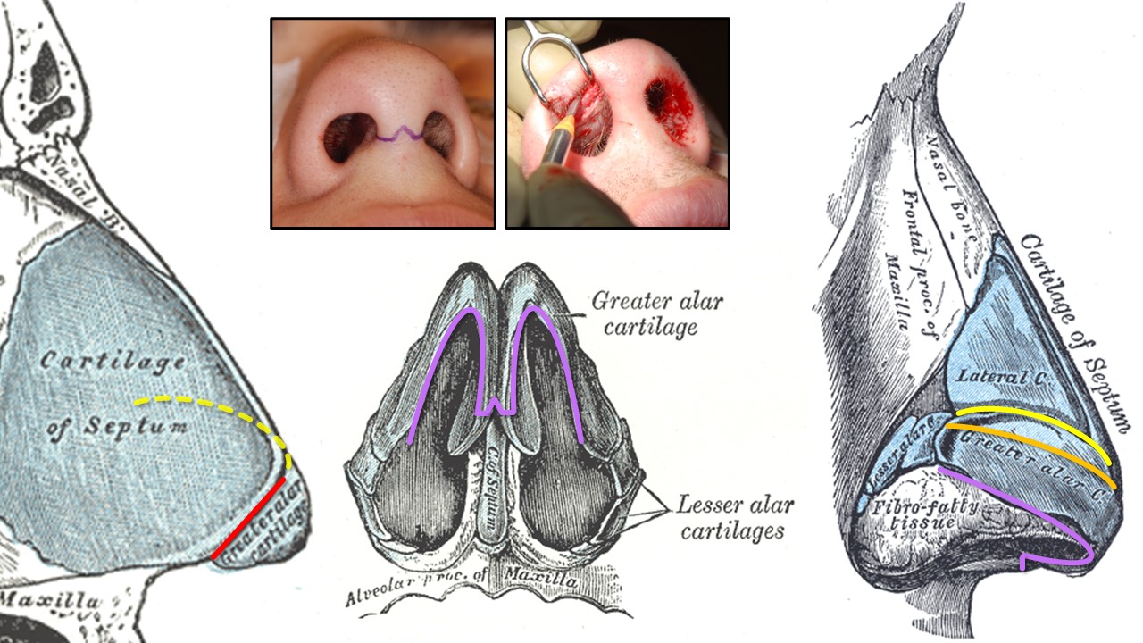 <p>&nbsp;</p>
<p>Rhinoplasty Incisions