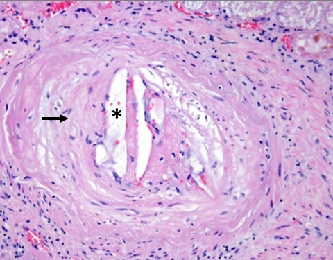 <p>Cholesterol Emboli in the Glomerulus, Histology, H&amp;E