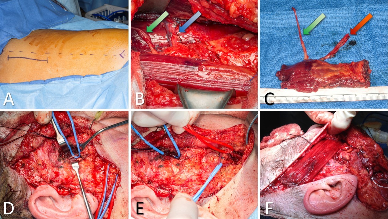 <p>Gracilis Free Flap for Facial Reanimation