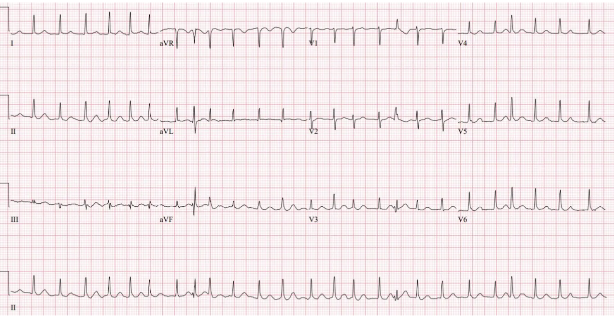 <p>Atrial Fibrillation Wide QRS Complex