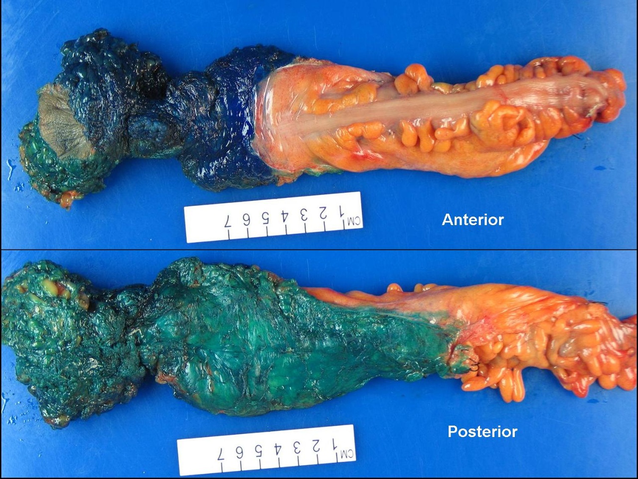 <p>Abdominoperineal Resection Specimen