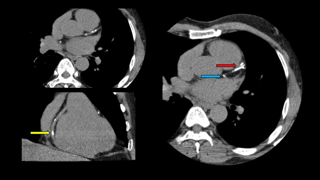 <p>Computed Tomography Coronary Angiogram