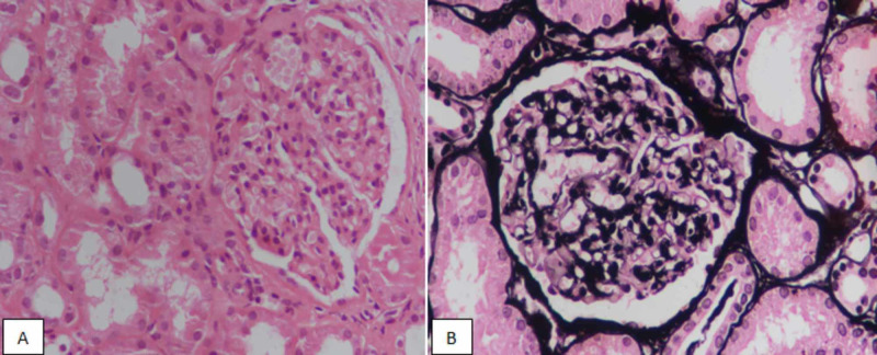 <p>Lupus Nephritis, Class II